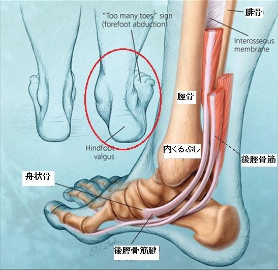 後脛骨筋腱機能不全症